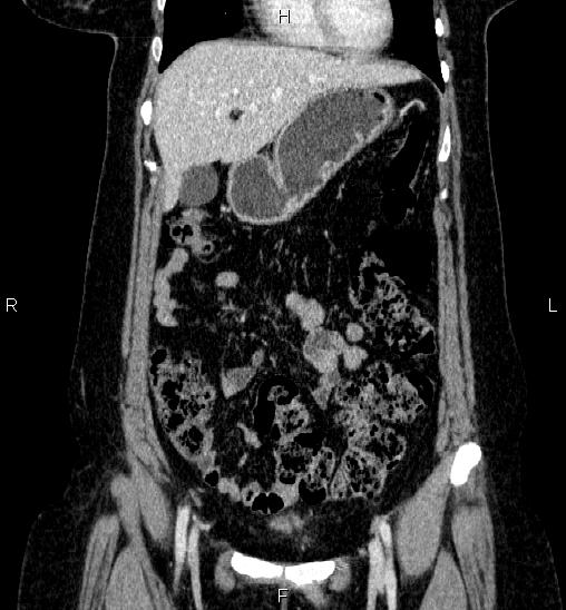 Adrenal cortical carcinoma (Radiopaedia 84882-100379 Coronal C+ portal venous phase 17).jpg