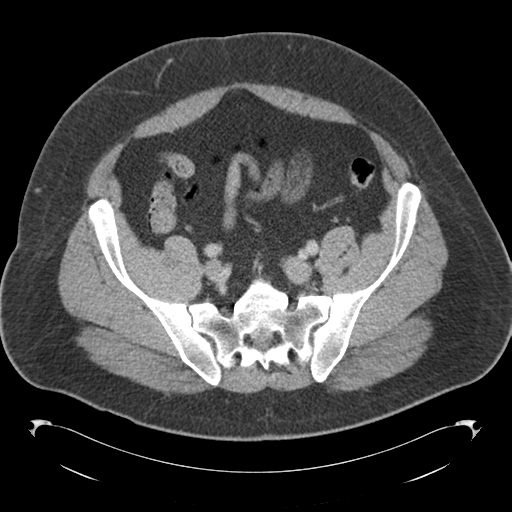 File:Adrenal cyst (Radiopaedia 45625-49776 Axial C+ portal venous phase 74).png