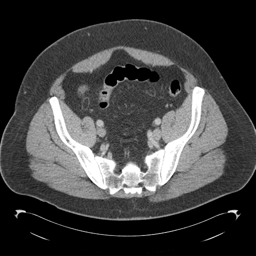 Adrenal cyst (Radiopaedia 45625-49776 Axial C+ portal venous phase 78).png