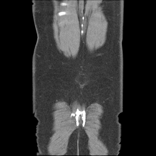 Adrenal cyst (Radiopaedia 45625-49776 Coronal C+ portal venous phase 66).png