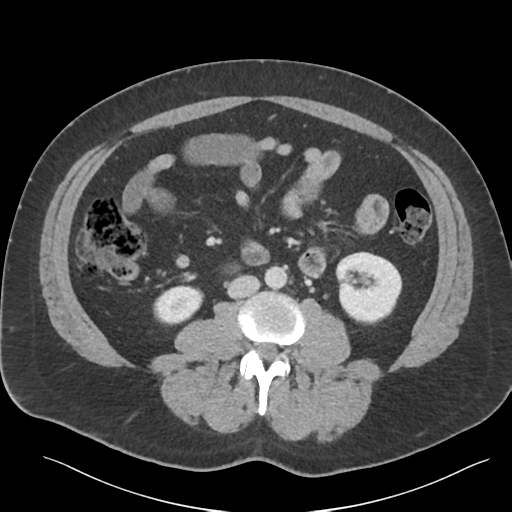 Adrenal cyst (Radiopaedia 45625-49777 Axial C+ portal venous phase 55).png