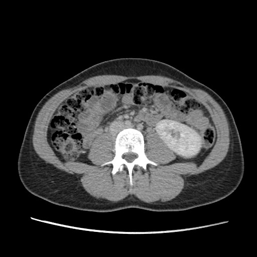 Adrenal cyst (Radiopaedia 64869-73813 Axial C+ portal venous phase 42).jpg