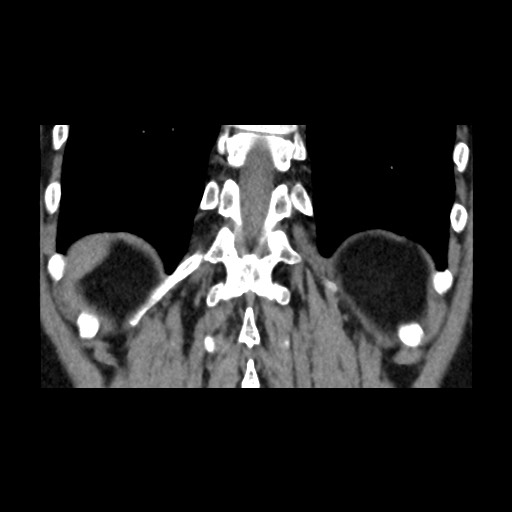 Adrenal gland trauma (Radiopaedia 81351-95079 Coronal non-contrast 73).jpg