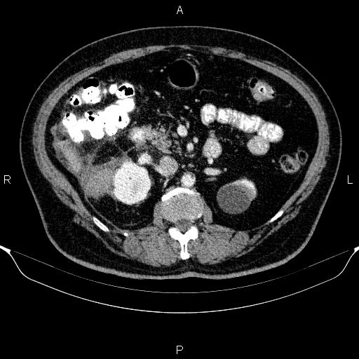 Adrenal hemorrhage (Radiopaedia 62622-70916 Axial C+ portal venous phase 76).jpg