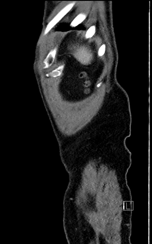 Adrenal lymphoma (Radiopaedia 73730-84529 Sagittal C+ portal venous phase 107).jpg