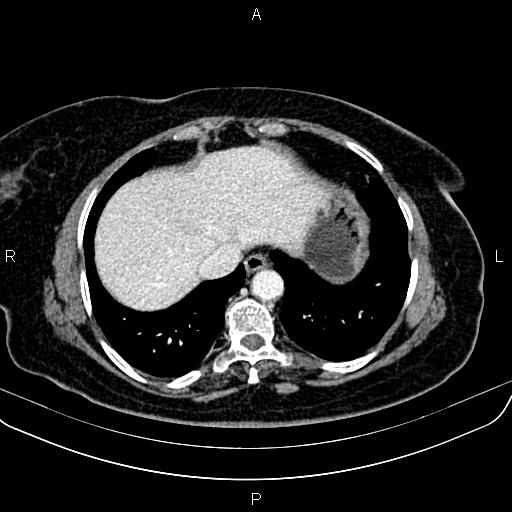 Adrenal myelolipoma (Radiopaedia 82742-96986 Axial renal cortical phase 17).jpg