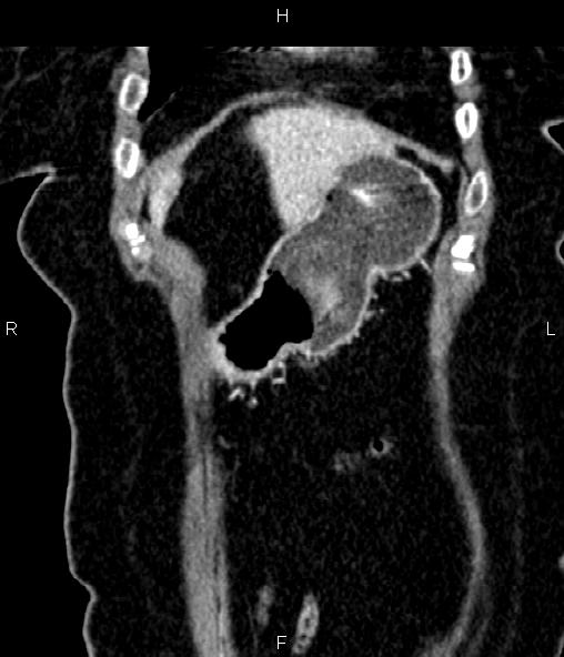 Adrenal myelolipoma (Radiopaedia 82742-96986 Coronal renal cortical phase 15).jpg