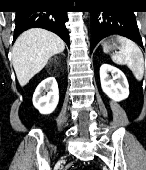 File:Adrenal myelolipoma (Radiopaedia 82742-96986 Coronal renal cortical phase 53).jpg