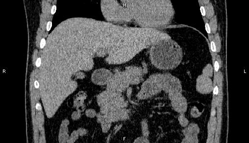Adrenal myelolipoma (Radiopaedia 84321-99619 Coronal non-contrast 31).jpg
