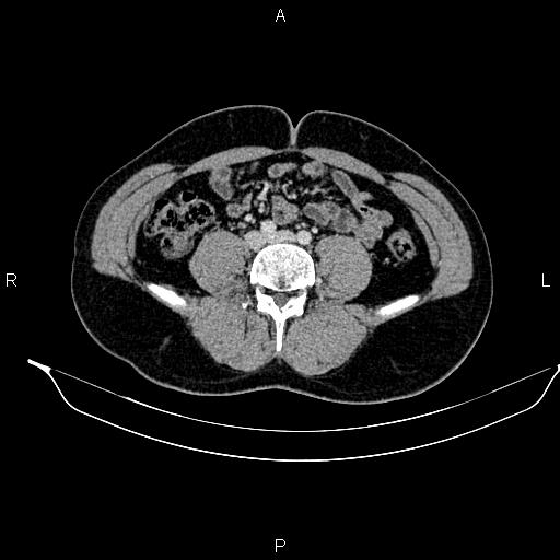 Adrenal myelolipoma (Radiopaedia 87794-104246 Axial renal cortical phase 67).jpg