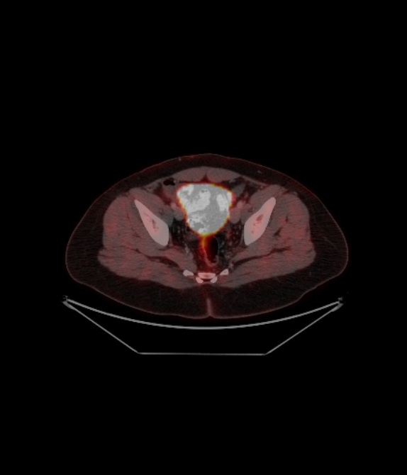 Adrenocortical carcinoma (Radiopaedia 80134-93440 ِAxial 237).jpg