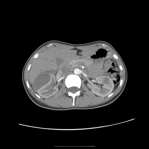 File:Adult polycystic kidney disease (Radiopaedia 48845-53876 Axial renal cortical phase 20).jpg