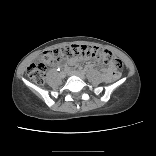 Adult polycystic kidney disease (Radiopaedia 48845-53876 Axial renal excretory phase 62).jpg