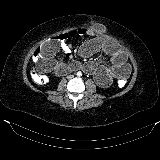 File:Afferent loop syndrome - secondary to incarcerated trocar site hernia (Radiopaedia 82959-97305 Axial C+ portal venous phase 134).jpg
