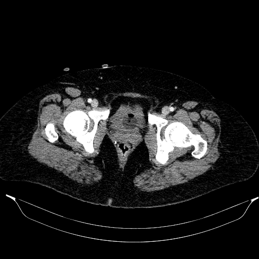 Afferent loop syndrome - secondary to incarcerated trocar site hernia (Radiopaedia 82959-97305 Axial C+ portal venous phase 229).jpg