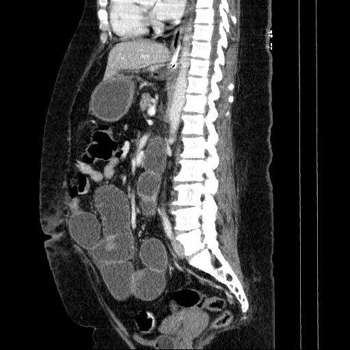 Afferent loop syndrome - secondary to incarcerated trocar site hernia (Radiopaedia 82959-97305 Sagittal C+ portal venous phase 72).jpg