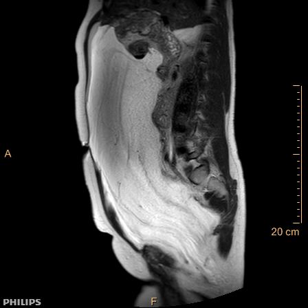 Aggressive angiomyxoma (Radiopaedia 73343-84093 Sagittal T2 25).jpg