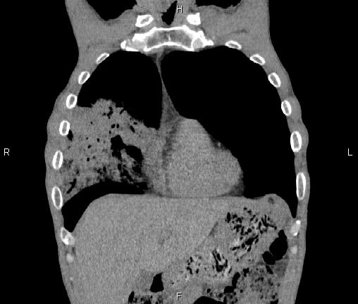 Air bronchogram in pneumonia (Radiopaedia 85719-101512 Coronal non-contrast 13).jpg