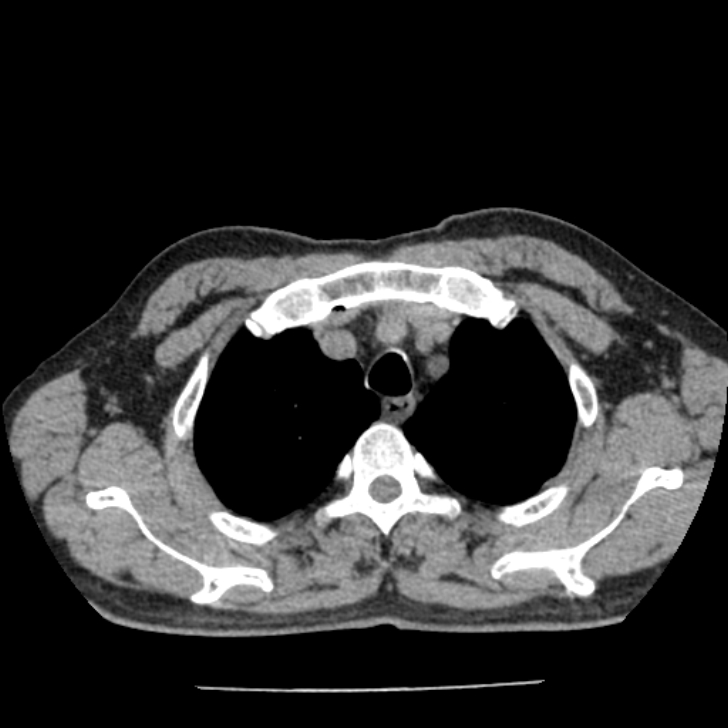 Airway foreign body in adult (Radiopaedia 85907-101779 Axial liver window 14).jpg