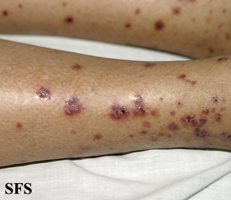 Allergic Vasculitis (Dermatology Atlas 9).jpg