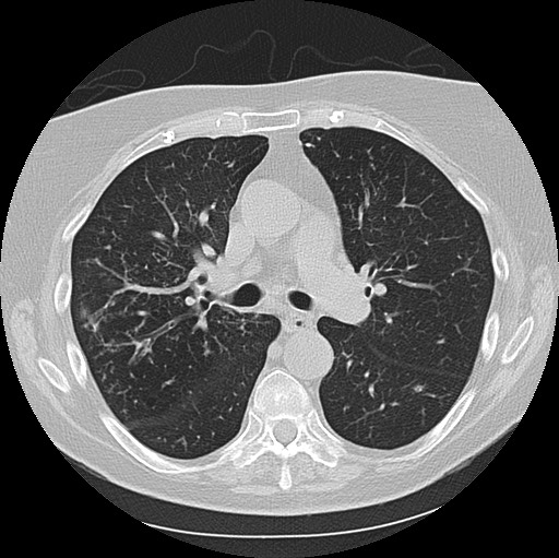 Alpha-1-antitrypsin deficiency (Radiopaedia 72058-82557 Axial lung window 30).jpg