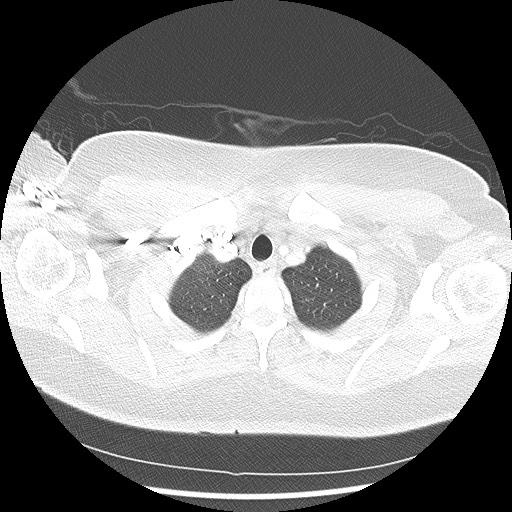 Alveolar soft part sarcoma - right leg (Radiopaedia 59432-67091 Axial lung window 15).jpg