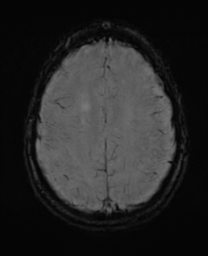 File:Alzheimer's disease- with Gerstmann syndrome and dressing apraxia (Radiopaedia 54882-61150 Axial SWI 26).png
