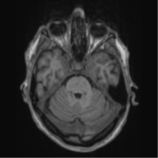 Alzheimer's disease- with apraxia (Radiopaedia 54763-61011 Axial T1 23).png