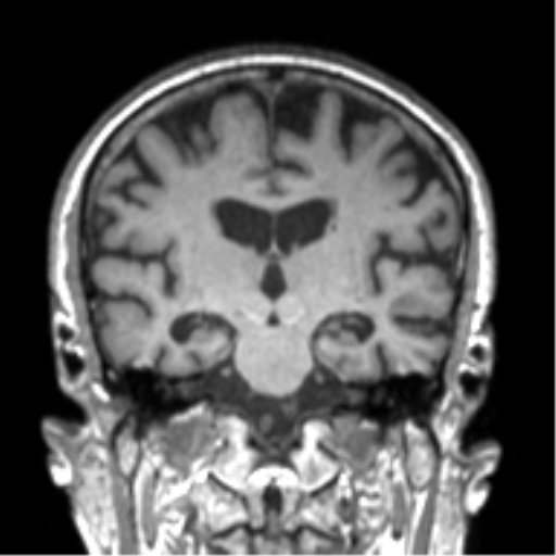 Alzheimer disease and cerebral amyloid angiopathy (Radiopaedia 64234-73011 Coronal T1 30).png