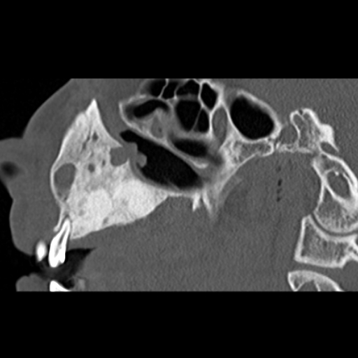 File:Ameloblastic fibro-odontoma (Radiopaedia 18843-18780 bone window 6).jpg