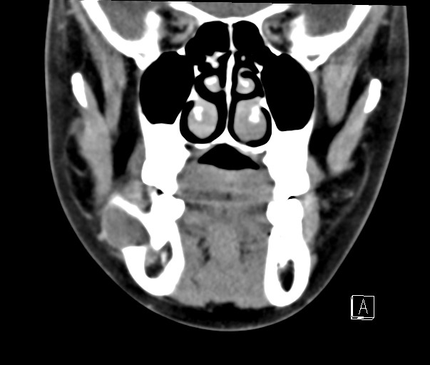 File:Ameloblastoma (Radiopaedia 26645-26793 Coronal C+ delayed 1).jpg
