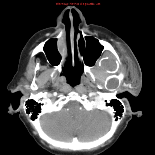 Ameloblastoma (Radiopaedia 27437-27631 A 16).jpg