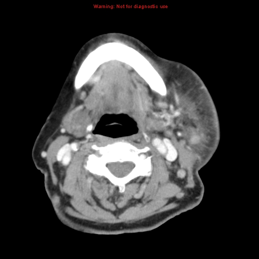 Ameloblastoma (Radiopaedia 27437-27631 A 52).jpg