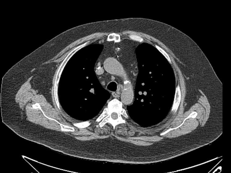 Amiodarone lung (Radiopaedia 62514-70769 Axial non-contrast 28).jpg