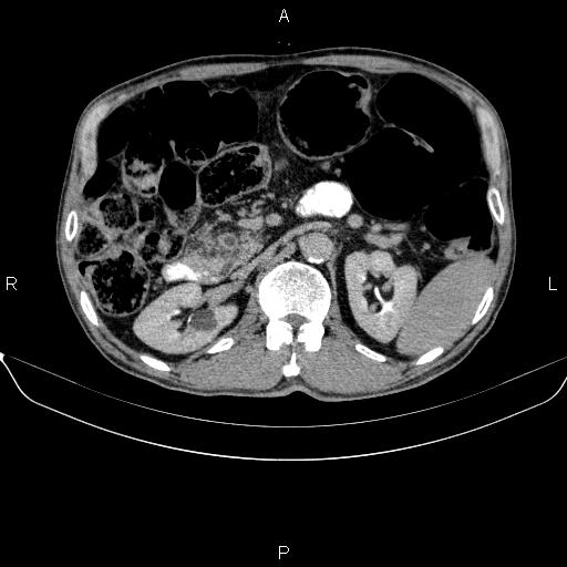 Ampullary adenocarcinoma (Radiopaedia 86093-102032 Axial C+ delayed 37).jpg