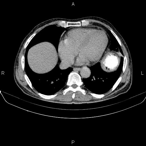 Ampullary adenocarcinoma (Radiopaedia 86093-102032 Axial C+ delayed 5).jpg