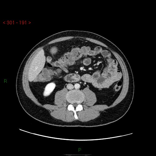Ampullary carcinoma (Radiopaedia 56396-63056 C 55).jpg