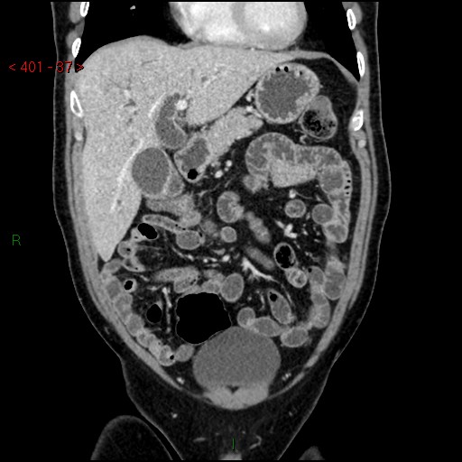 Ampullary carcinoma (Radiopaedia 56396-63056 E 36).jpg