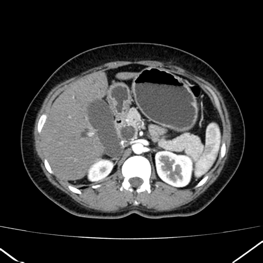 Ampullary tumor (Radiopaedia 22787-22816 B 30).jpg