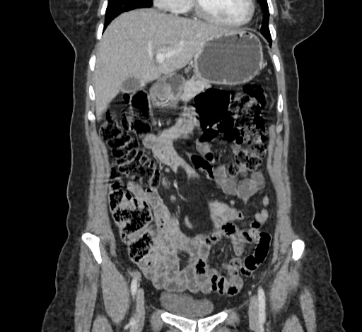 Ampullary tumor (Radiopaedia 60333-67998 B 23).jpg