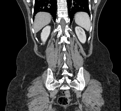File:Ampullary tumor (Radiopaedia 60333-67998 B 65).jpg