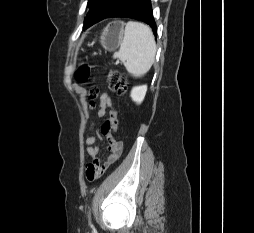 File:Ampullary tumor (Radiopaedia 60333-67998 C 51).jpg