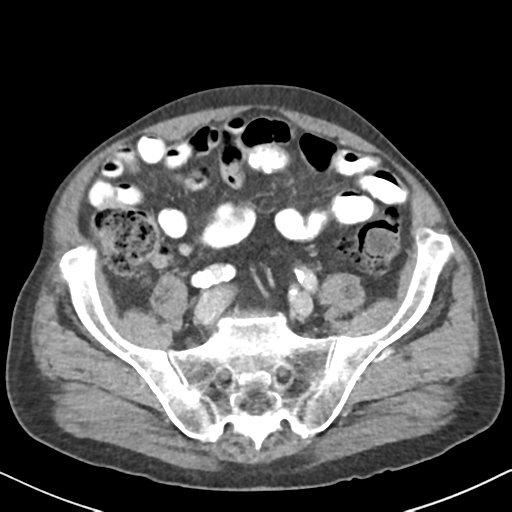 File:Amyand hernia (Radiopaedia 39300-41547 A 52).png