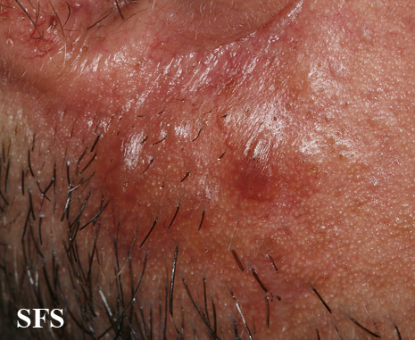 Amyloidosis-Nodular Amyloidosis (Dermatology Atlas 7).jpg