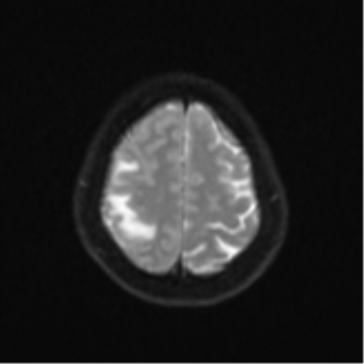 Anaplastic astroblastoma (Radiopaedia 55666-62194 Axial DWI 24).png