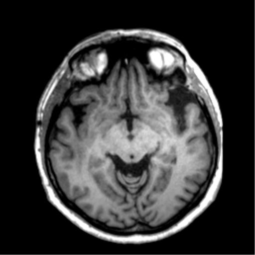 Anaplastic astrocytoma IDH wild-type (pseudoprogression) (Radiopaedia 42209-45277 Axial T1 57).png