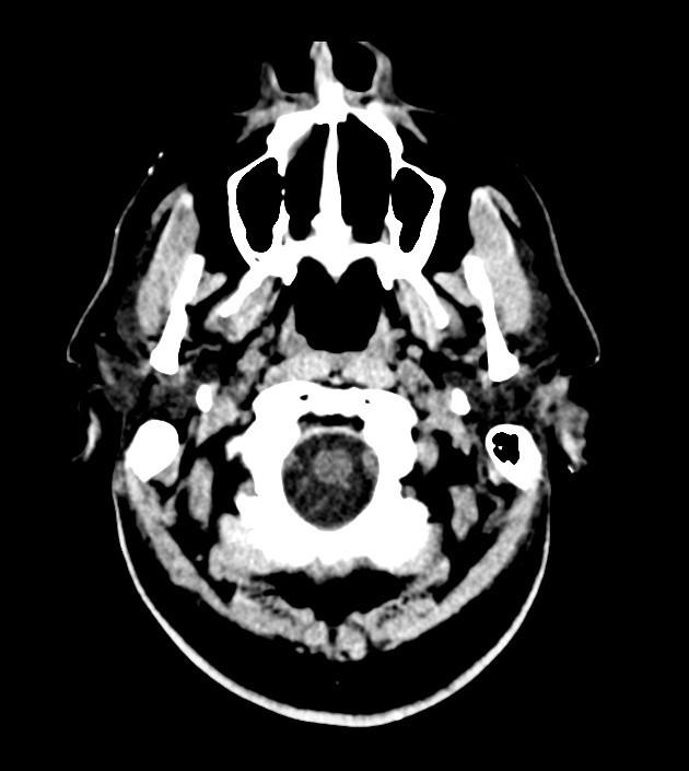 Anaplastic oligodendroglioma (Radiopaedia 79571-92758 Axial non-contrast 3).jpg