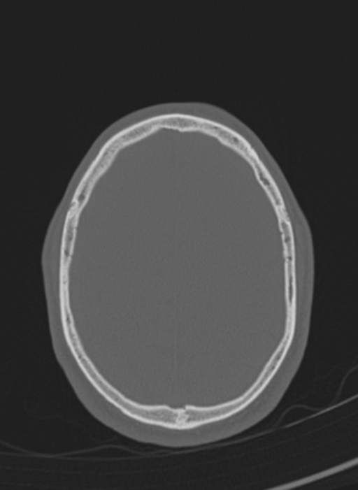 Anaplastic oligodendroglioma with skull fracture (Radiopaedia 74831-85846 Axial bone window 7).png