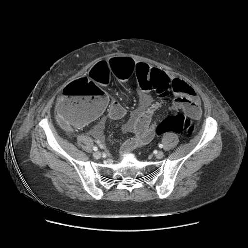 Anastomosis leak at ileostomy closure site (Radiopaedia 82138-96184 B 174).jpg