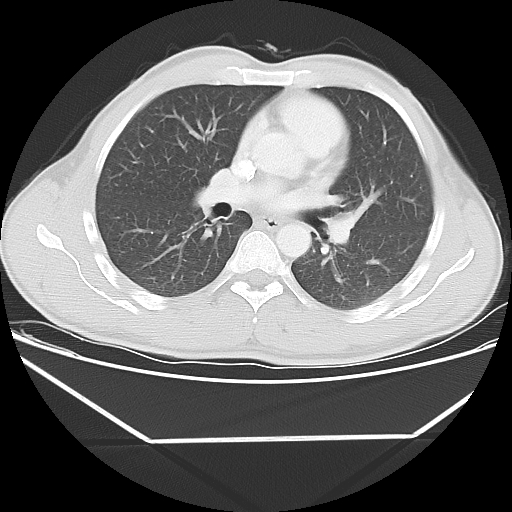 File:Aneurysmal bone cyst - rib (Radiopaedia 82167-96220 Axial lung window 34).jpg